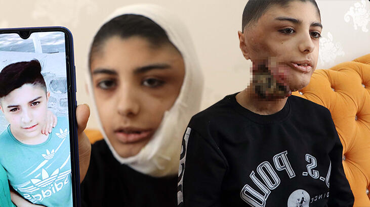  Sol gözü kaybetmek üzere...