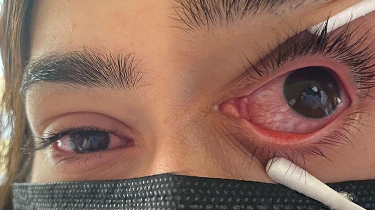  Uzmanlar adenovirüse karşı uyarıyor