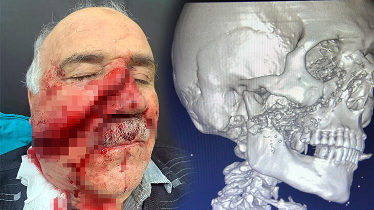  Yer: Kahramanmaraş! Demir keserken yüzü parçalandı