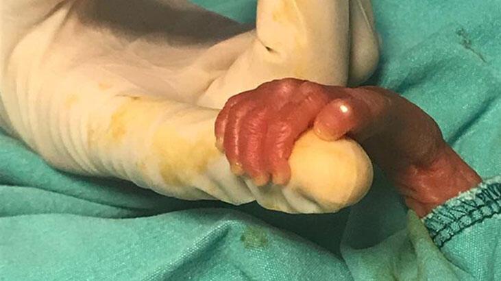 540 gramlık parmak bebek Rabia'yı kök hücre tedavisi hayata bağladı