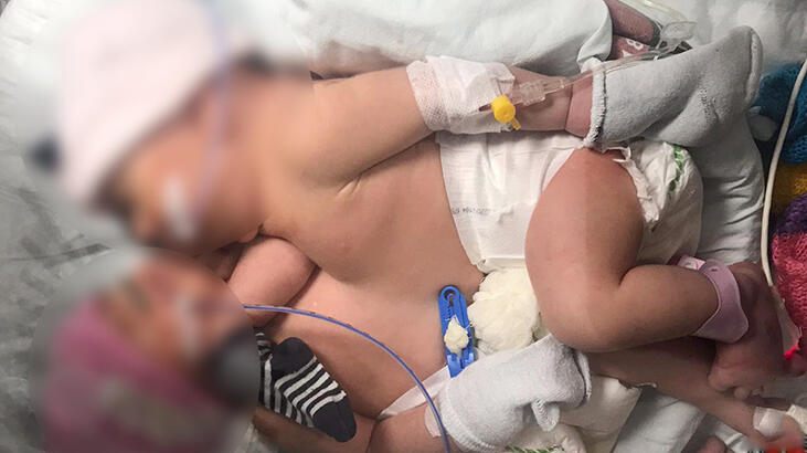 8 gün sonra Cerrahpaşa'dan gelen müthiş haber! Siyam ikizleri ayrıldı