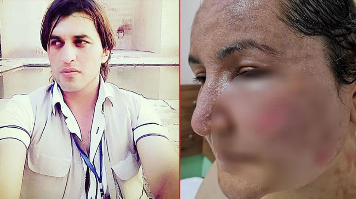Cani eşinin kızgın yağla yüzünü yaktığı kadın yaşadıklarını anlattı: 'Seni televizyona çıkaracağım' diyordu, demek ki bunu planlıyormuş