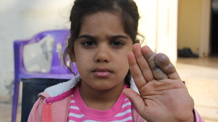 Doğuştan damar tıkanıklığı hastası küçük Vahide şifa arıyor