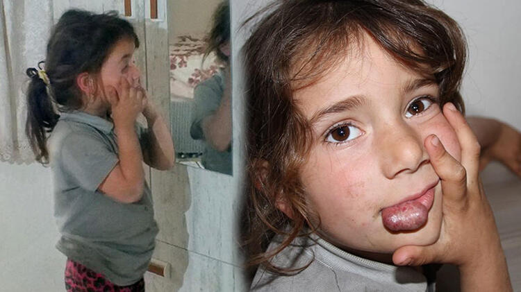 Dudağındaki kitle her geçen gün büyüyor! Rabia yardım bekliyor