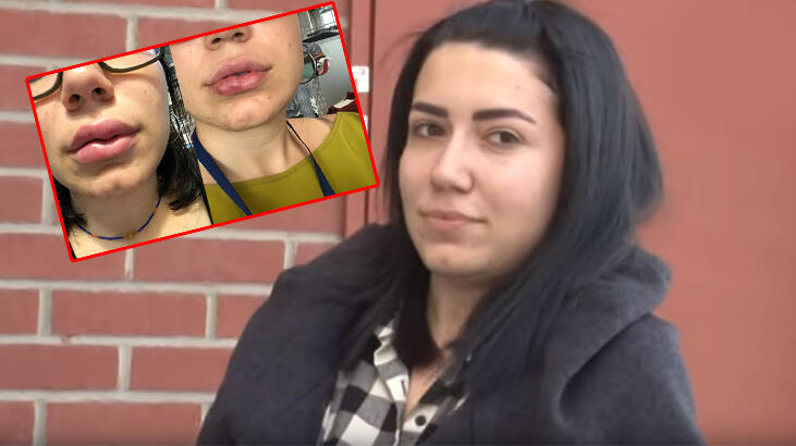 Dudakları bu hale geldi! Ortaya çıktı: Memnun olmuştu!