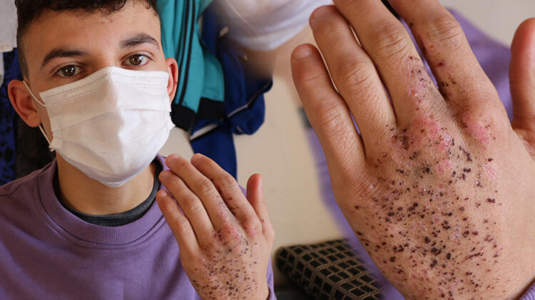 Edirne'de yıldırım düşmesi sonucu yaralanan genç iyileşti