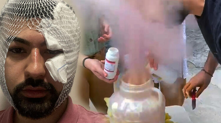 ‘Fildişi macunu deneyi’ yaparken püsküren kimyasal madde yüzünü yaktı