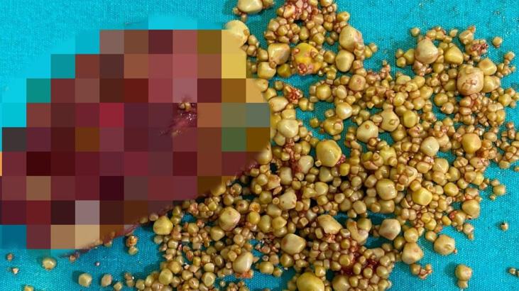 Hastanede büyük şok yaşadı! Safra kesesinden 1284 taş çıktı