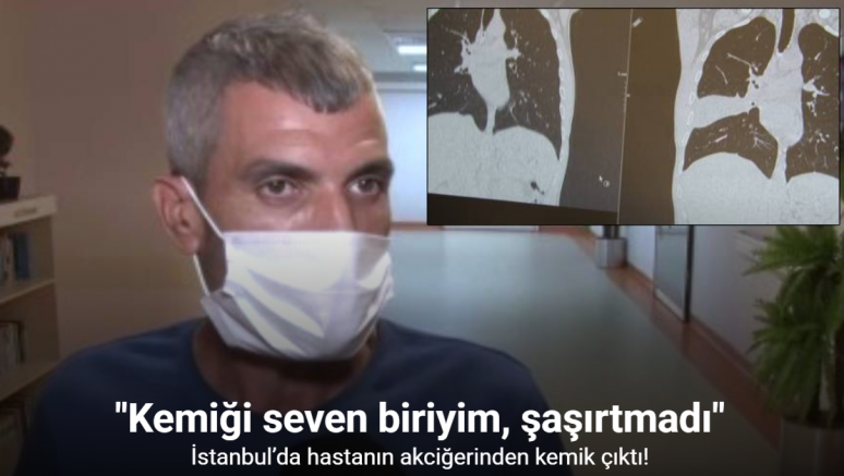 İstanbul’da hastanın akciğerinden kemik çıktı: 