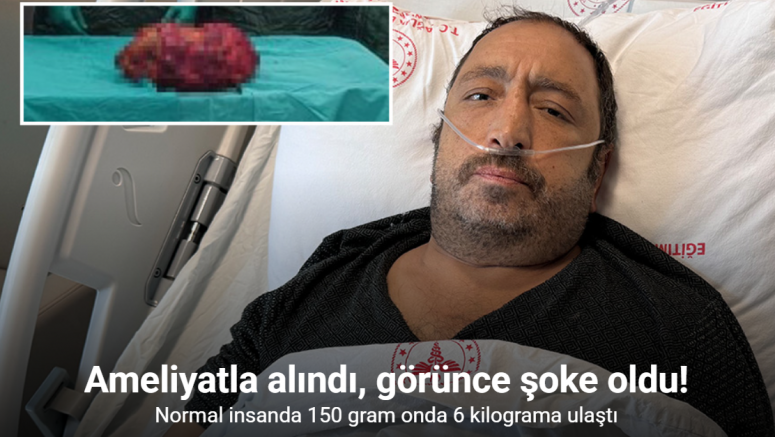Mardin’de 6 kiloluk böbrek, ameliyatla alındı