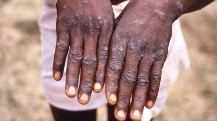 Maymun Çiçeği virüsü (Monkeypox) nedir, belirtileri nelerdir? Maymun Çiçeği virüsü hangi ülkelerde görüldü?