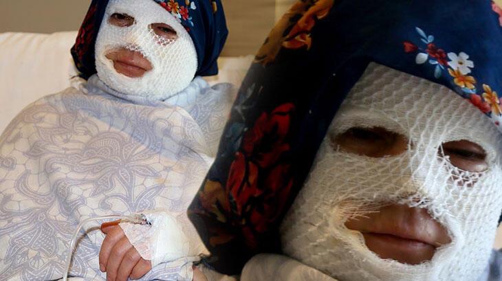 Patlayan düdüklü tencere yüzünde ve vücudunda derin yanıklar oluşturdu