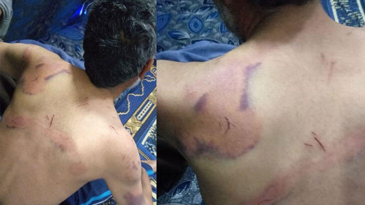 PKK işkencesinde böbreği çalışamaz hale geldi