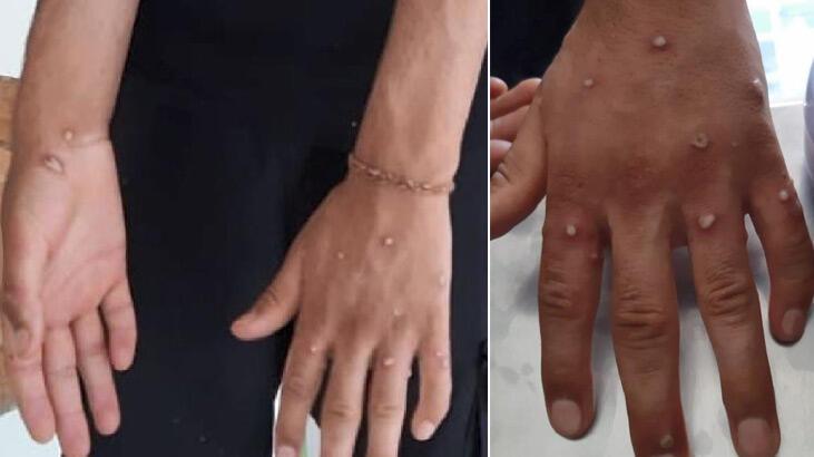 Sultangazi'de 'maymun çiçeği' hareketliliği