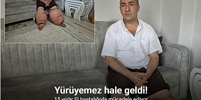 15 yıldır fil hastalığıyla mücadele ediyor