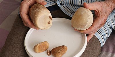 73 yaşındaki hastanın mesanesinden 2 kilo taş çıktı!
