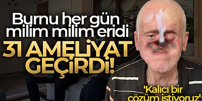 Burnu her gün milim milim eridi, 31 ameliyat geçirdi