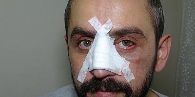 DHA muhabirine çirkin saldırı: Kısıtlamayı ihlal eden boksör, gazetecinin burnunu kırdı 