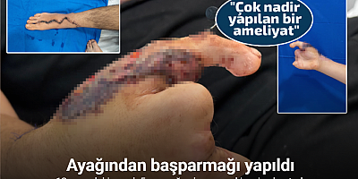 Parmaklarını kıyma makinesine kaptıran 13 yaşındaki çocuğa ayağından nakil