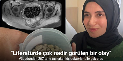 Vücudundan 287 tane taş çıkarıldı, doktorlar bile şok oldu: 