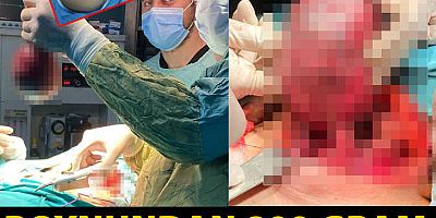 Yıllarca ameliyattan korkan hasta ikna edildi, boynundan 800 gram kitle çıktı