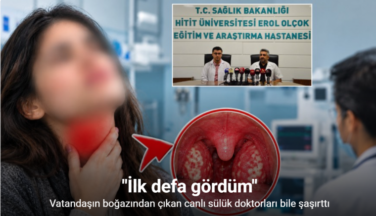Vatandaşın boğazından çıkan canlı sülük doktorları bile şaşırttı: 