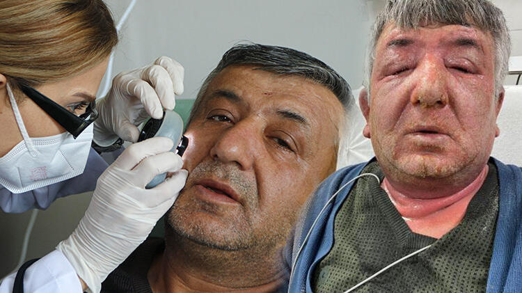 Yüzüne sürdüğü dezenfektan hastanelik etti!